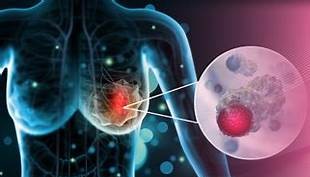 Experts Advocate Nationwide Rollout Of Patient Navigation System Against Breast Cancer